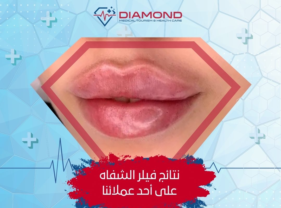 فيلر الشفايف