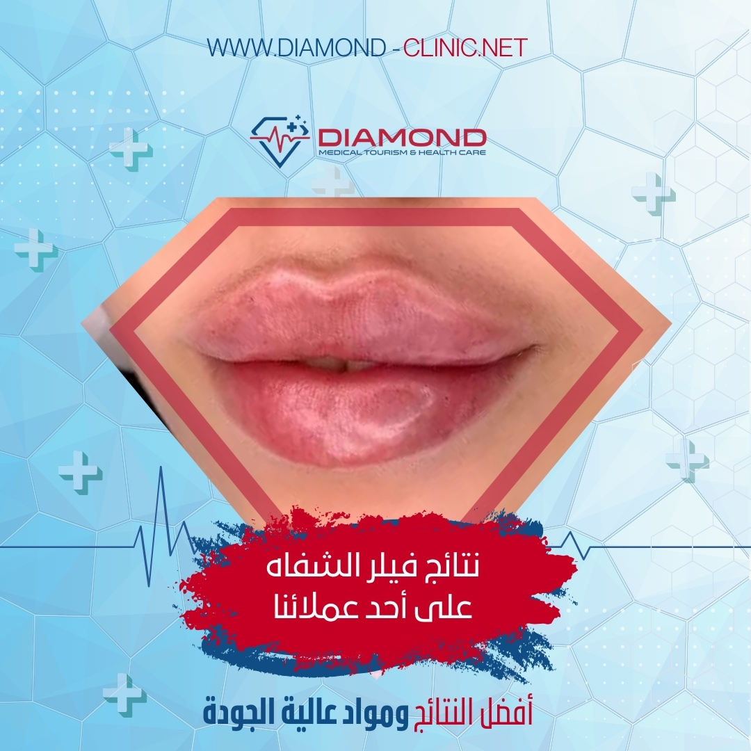 فيلر الشفايف